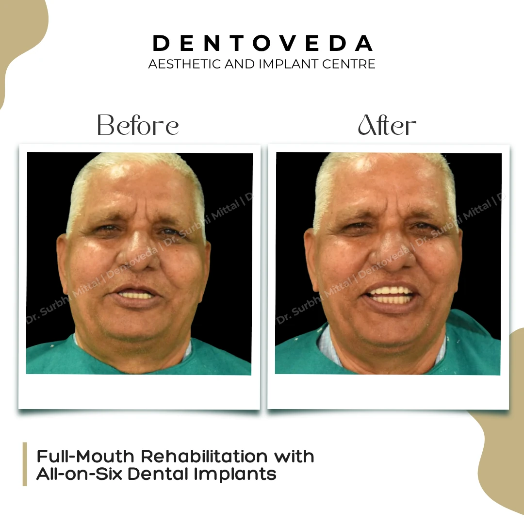 Before and after: All on 6 Dental Implants