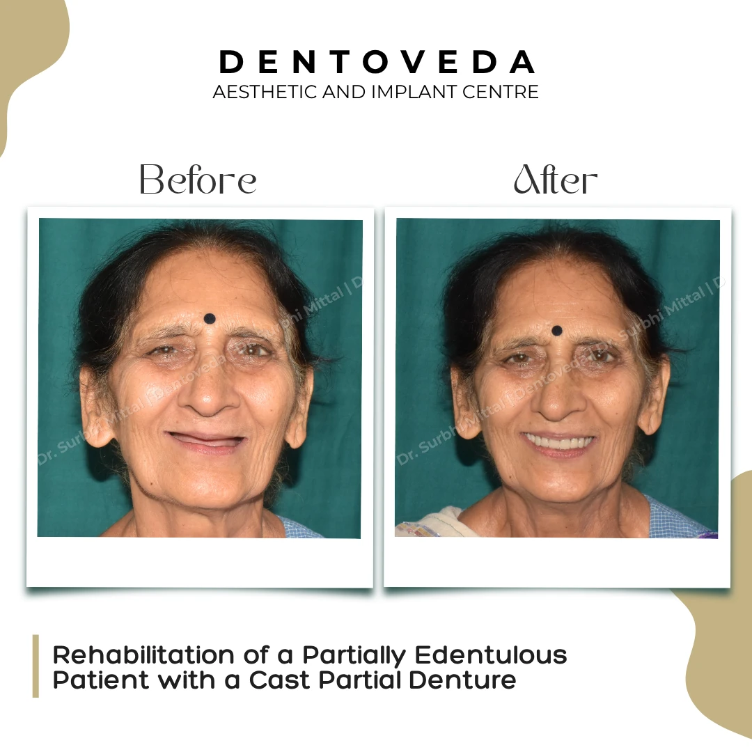 Before and after: Cast Partial Denture