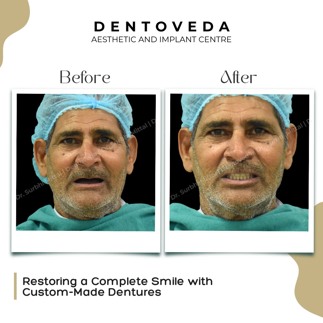 Before and after: Complete Dentures