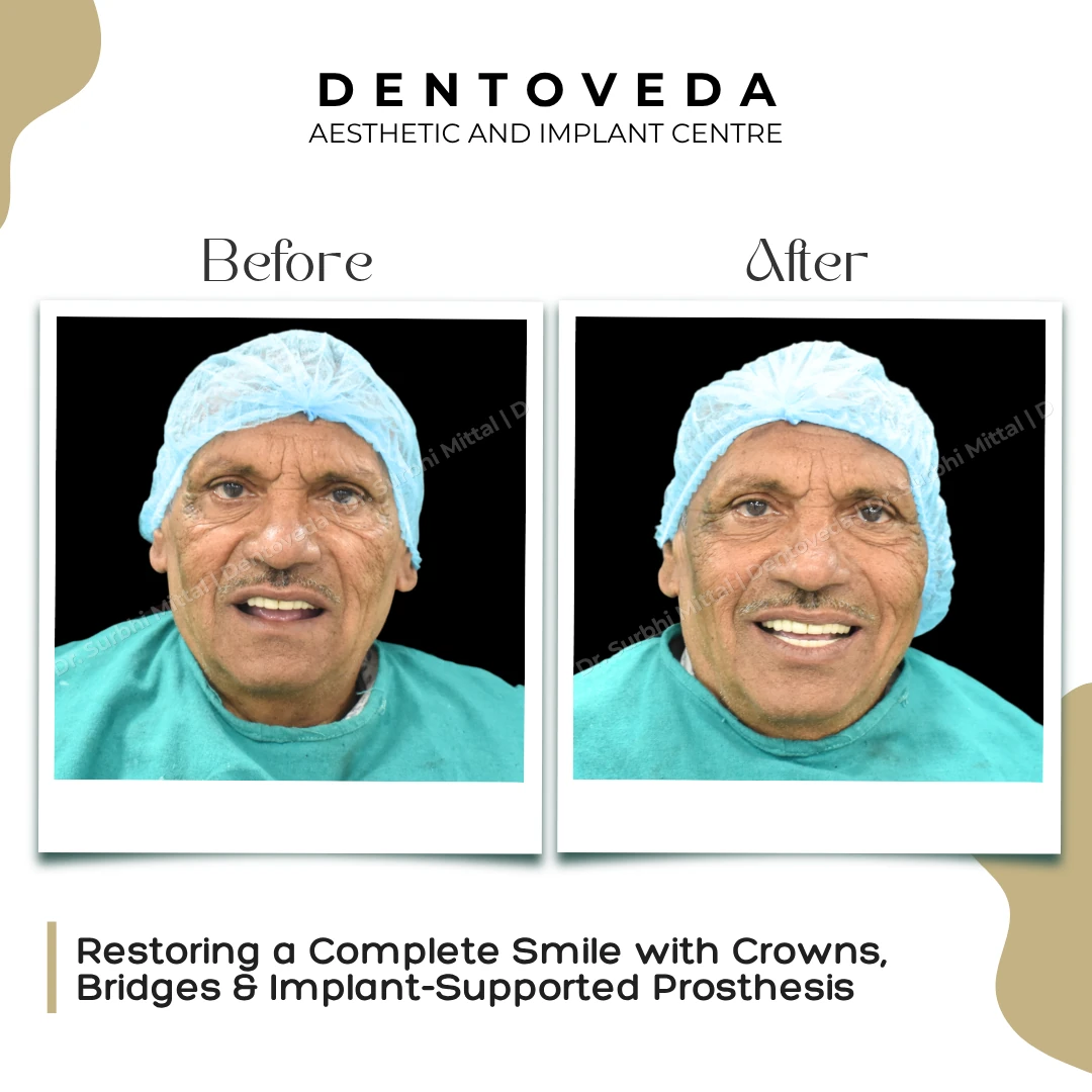 Before and after: Crowns Bridges Dental Implants
