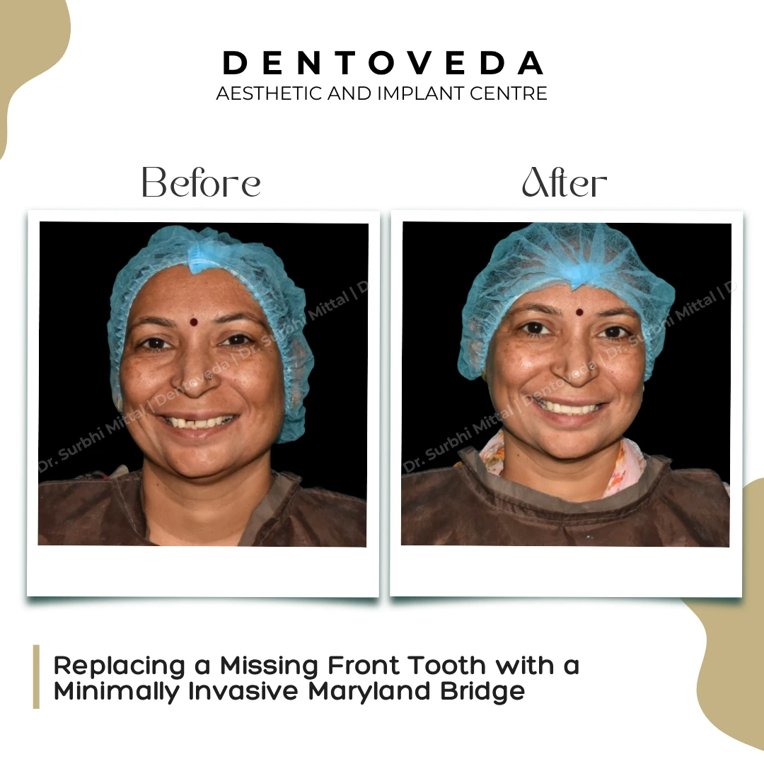 Before and after: Maryland Bridge