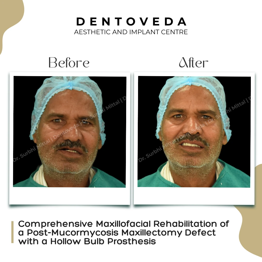 Before and after: Maxillofacial Rehabilitation
