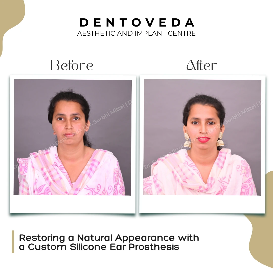 Before and after: Silicone Ear Prosthesis
